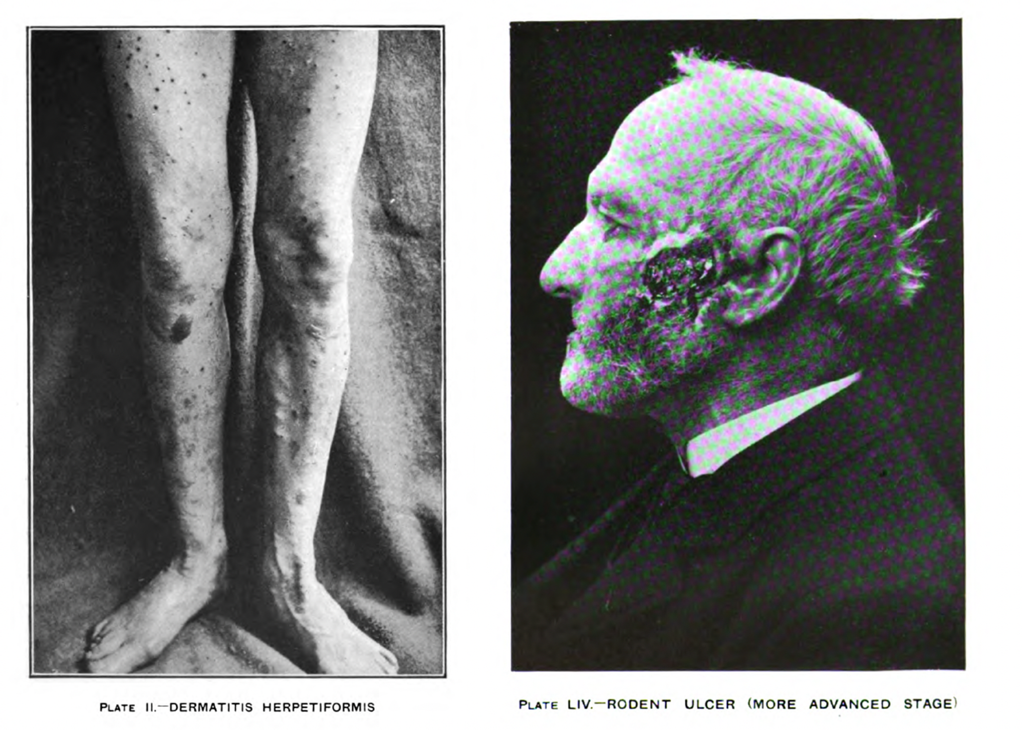 Purcell Fig. 4. Two images from Sir. Malcolm Morris’ Diseases of the Skin (1909). The left plate displays a visual rhetoric of anatomizing the photographic subject by cutting and framing their body to display the disease in isolation. The right plate displays a more general image where some identifying aspects of the sitter are made viewable. 