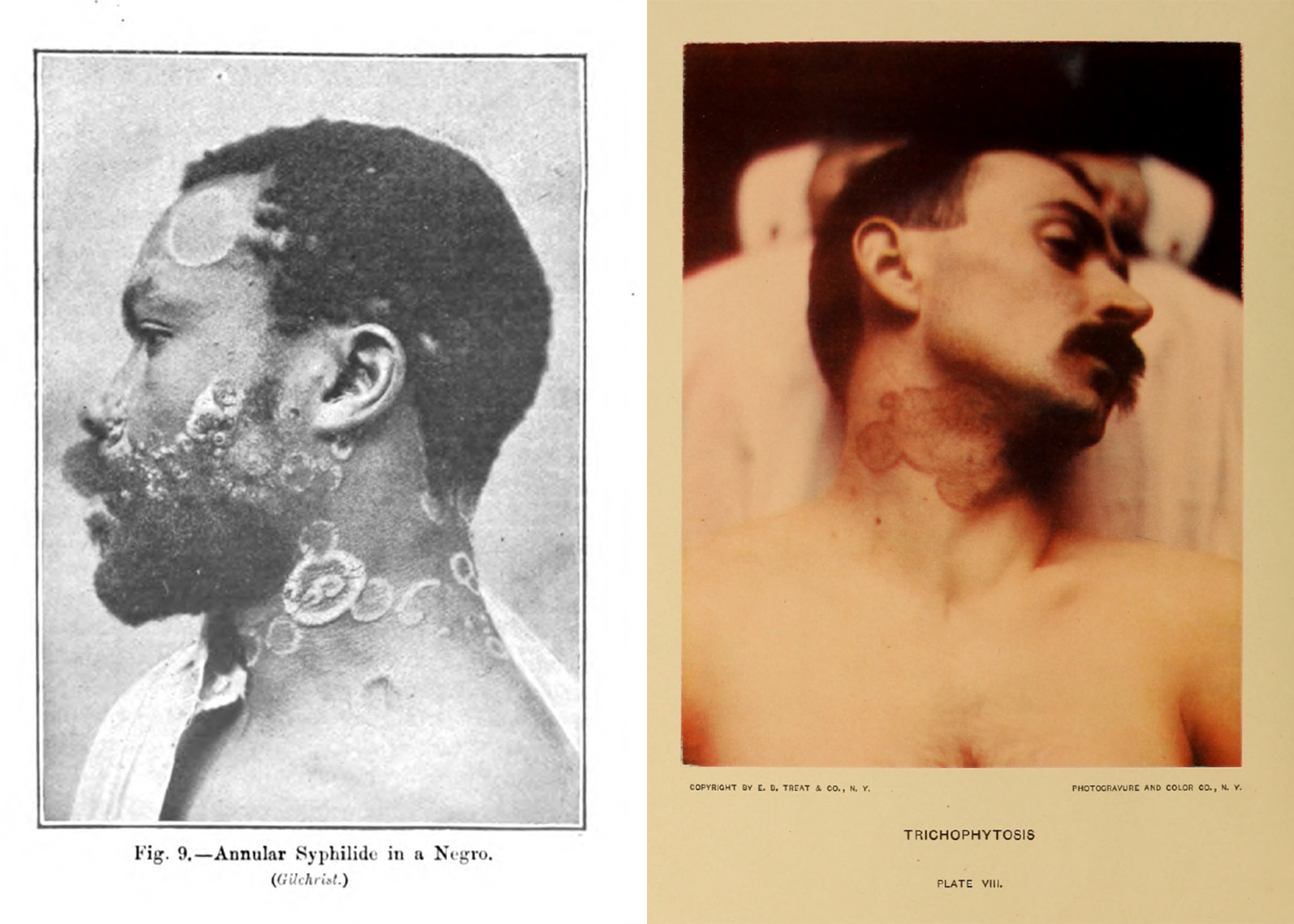 Purcell Fig 5. Left: Racial definitions are traded unproblematically in Sir Malcom Morris’ Diseases of the Skin (1909). Right: The white body is deemed normal, and thus needs not be addressed as unique, in William S. Gottheil’s Illustrated Skin Diseases (1906).