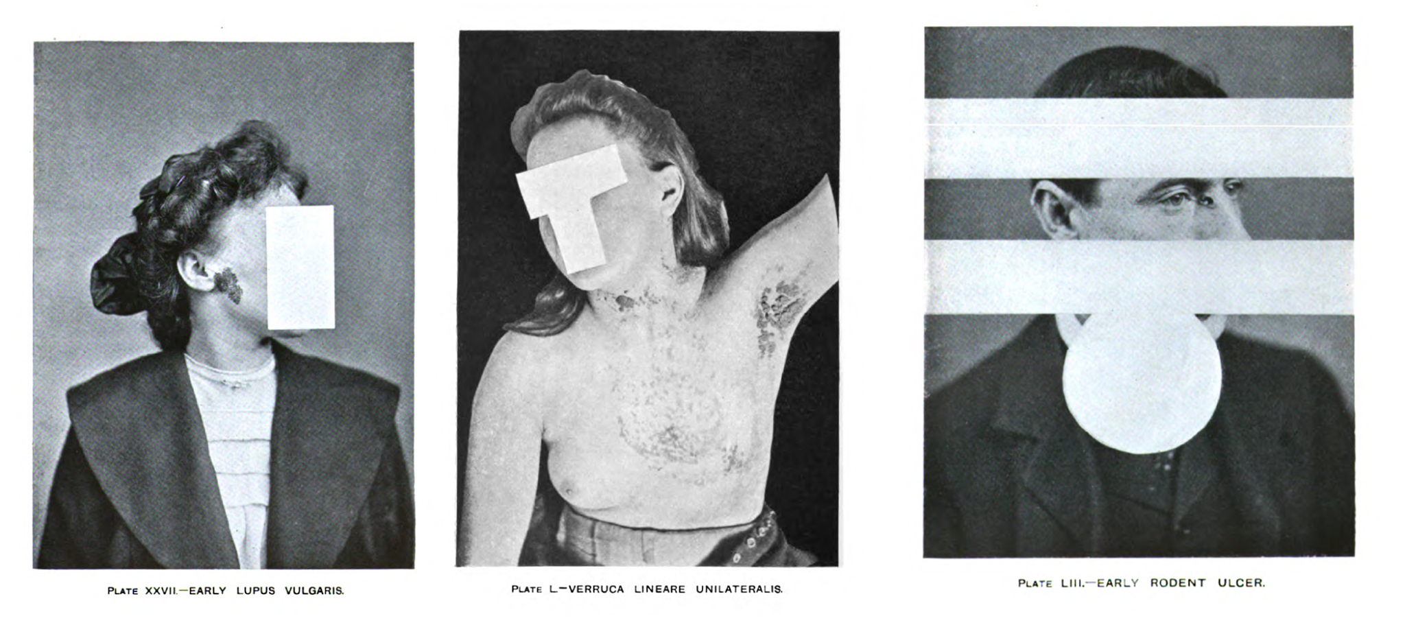 Purcell figure six. Three black and white images of persons with skin conditions have been obscured using white geometric shapes.