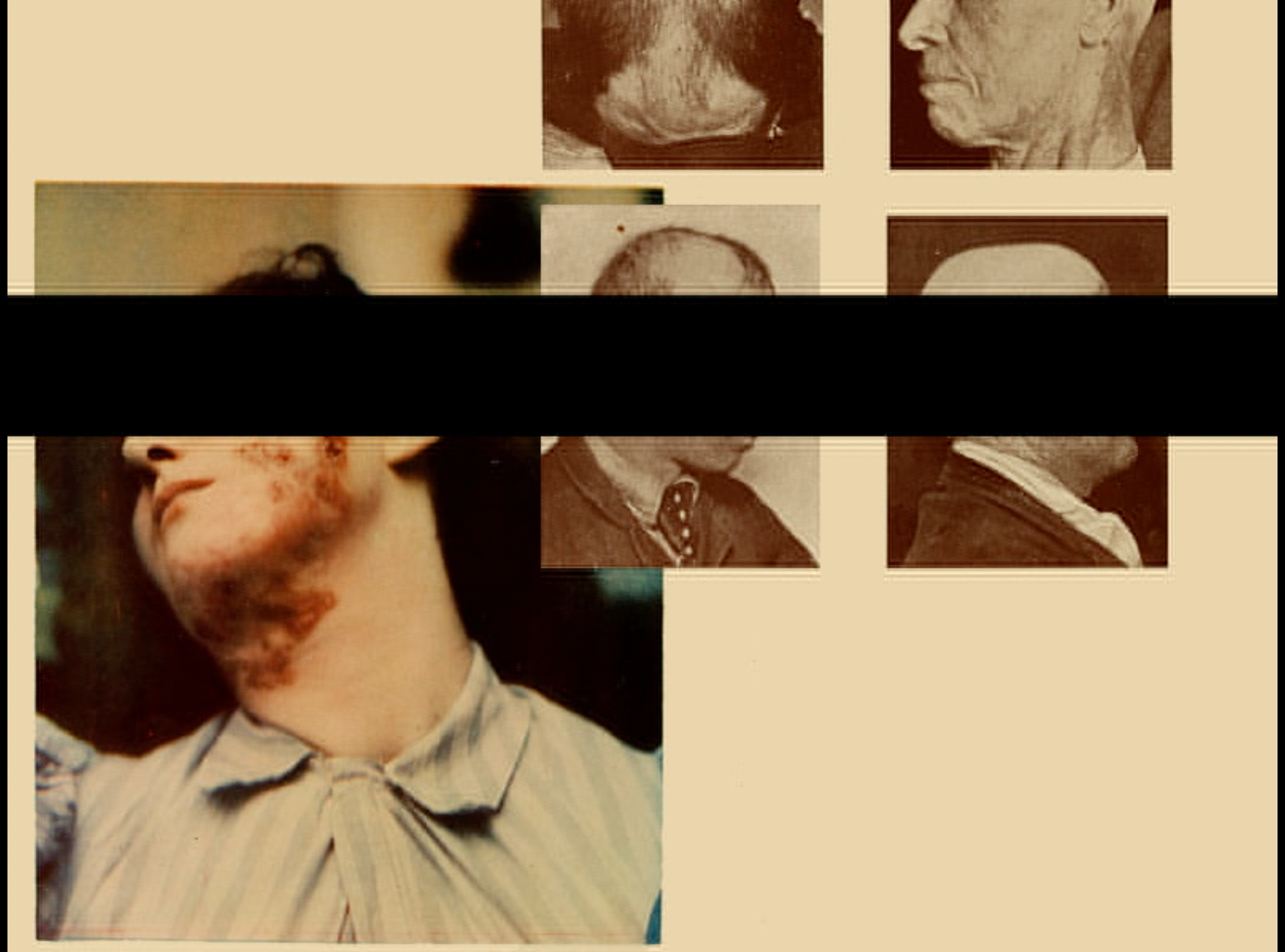 Purcell figure 7. One large photo in color shows an individual with a skin condition on their neck and face; their eyes are obscured by a black bar. Four smaller black and white photos are arranged in a grid at the top, two of which are also obscured by the same black bar